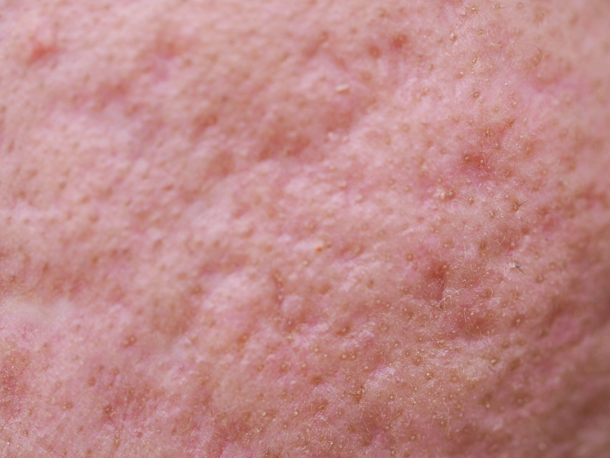 10 Acne Scar Treatments By The Dermatologist