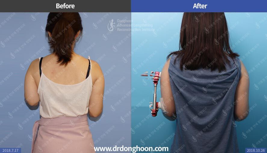 Arm Lengthening Limb Lengthening & Complex Reconstruction Service