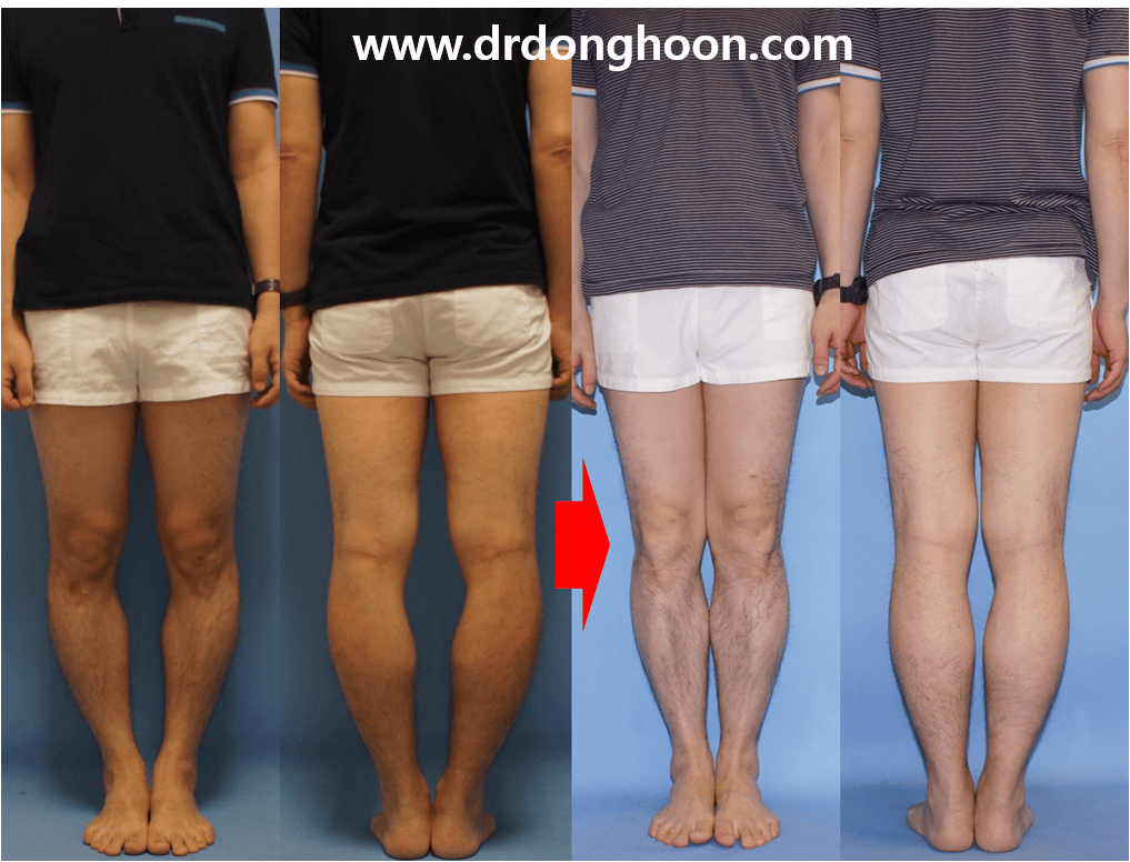 InDepth Analysis of Leg Deformity (Bowleg) 1 on Rotational Deformity Limb Lengthening