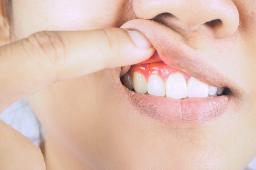 Recognizing The 5 Early Signs Of Gum Disease