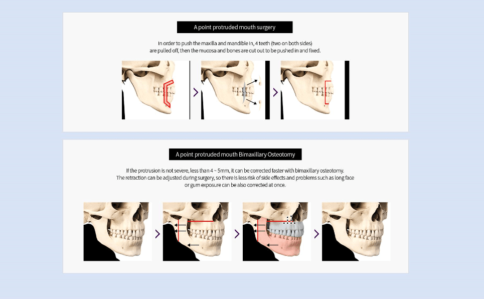 Double Jaw Surgery in Singapore Correct Jaw Alignment Issues