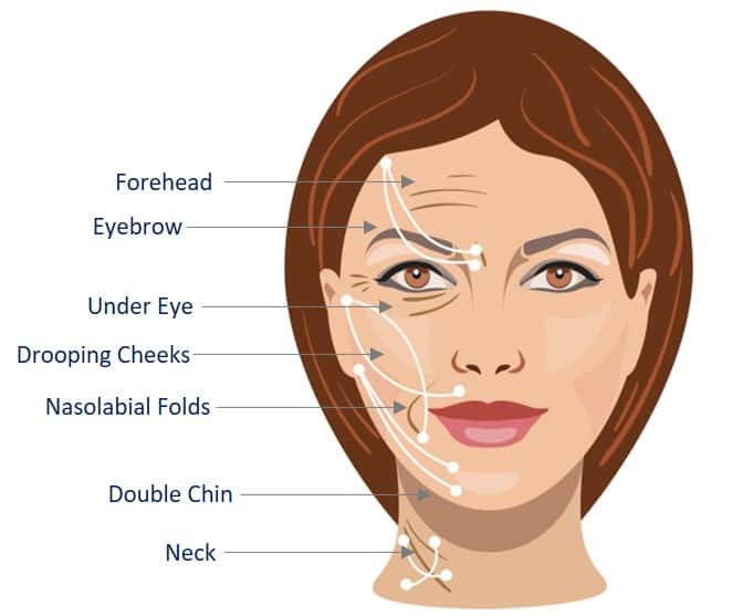 What You Should & Should not Do after Thread Lift in Singapore