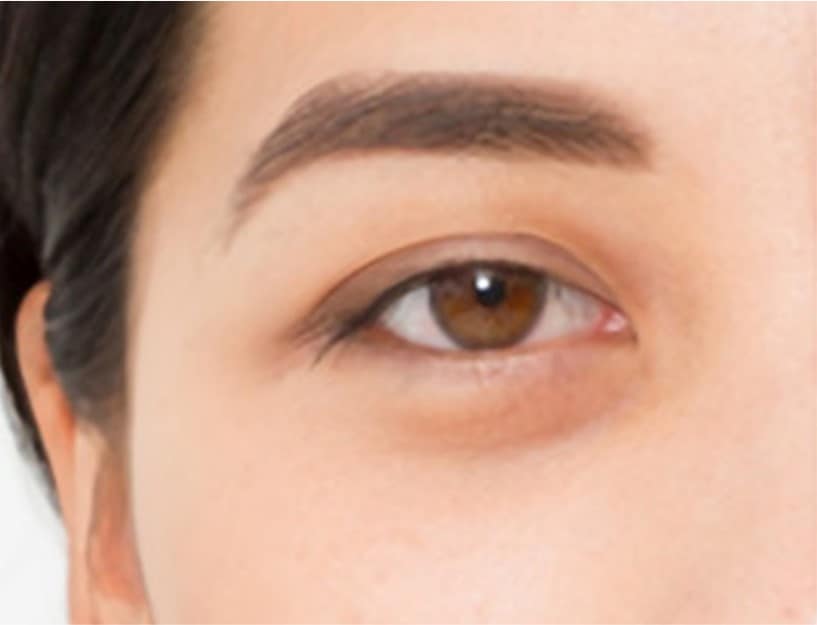 All You Need To Know About eye bag treatment Noninvasive Remedies and Surgery Dream Plastic