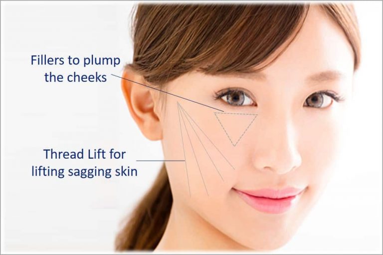 Thread Lift In Singapore Versus Fillers For Sagging Skin Which Is