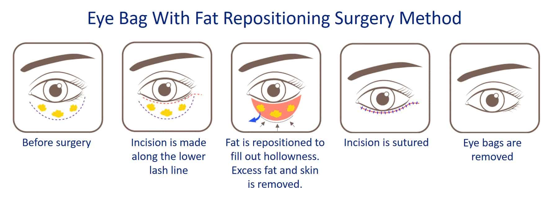 Eye Bag Removal in Singapore Aesthetic or Plastic Surgery?