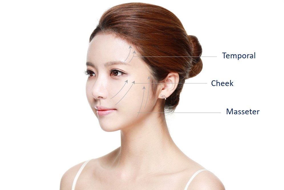 Thread Lifts In Singapore Pricing Guide For NonSurgical Facelifts Dream Plastic Surgery