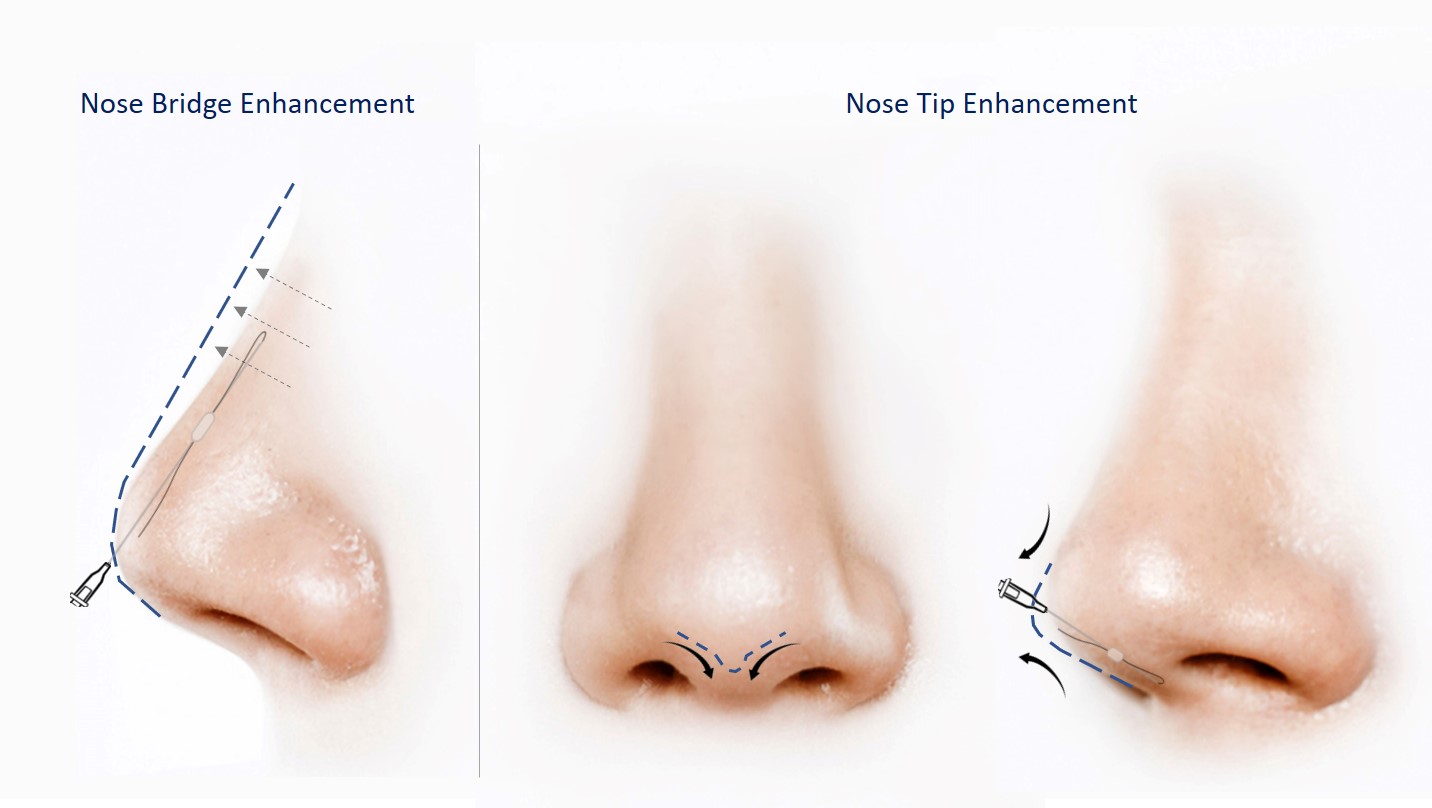 Nose Fillers Vs. Thread Lift Which Is Better? Dream Plastic Surgery