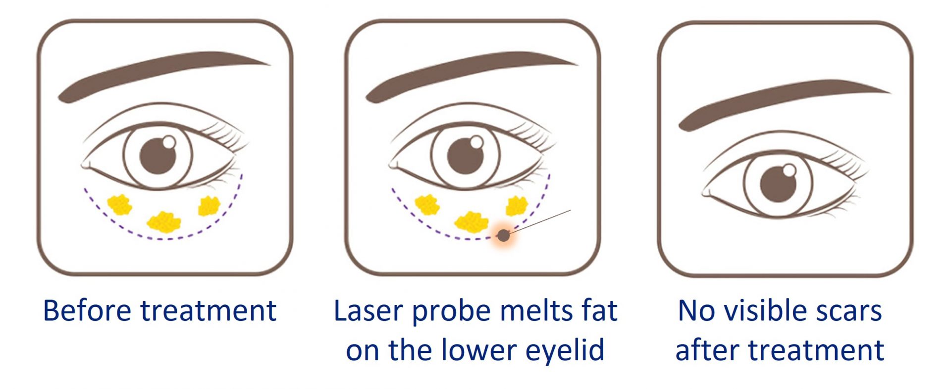 Surgical & NonSurgical Eye Bag Removal Cost in Singapore