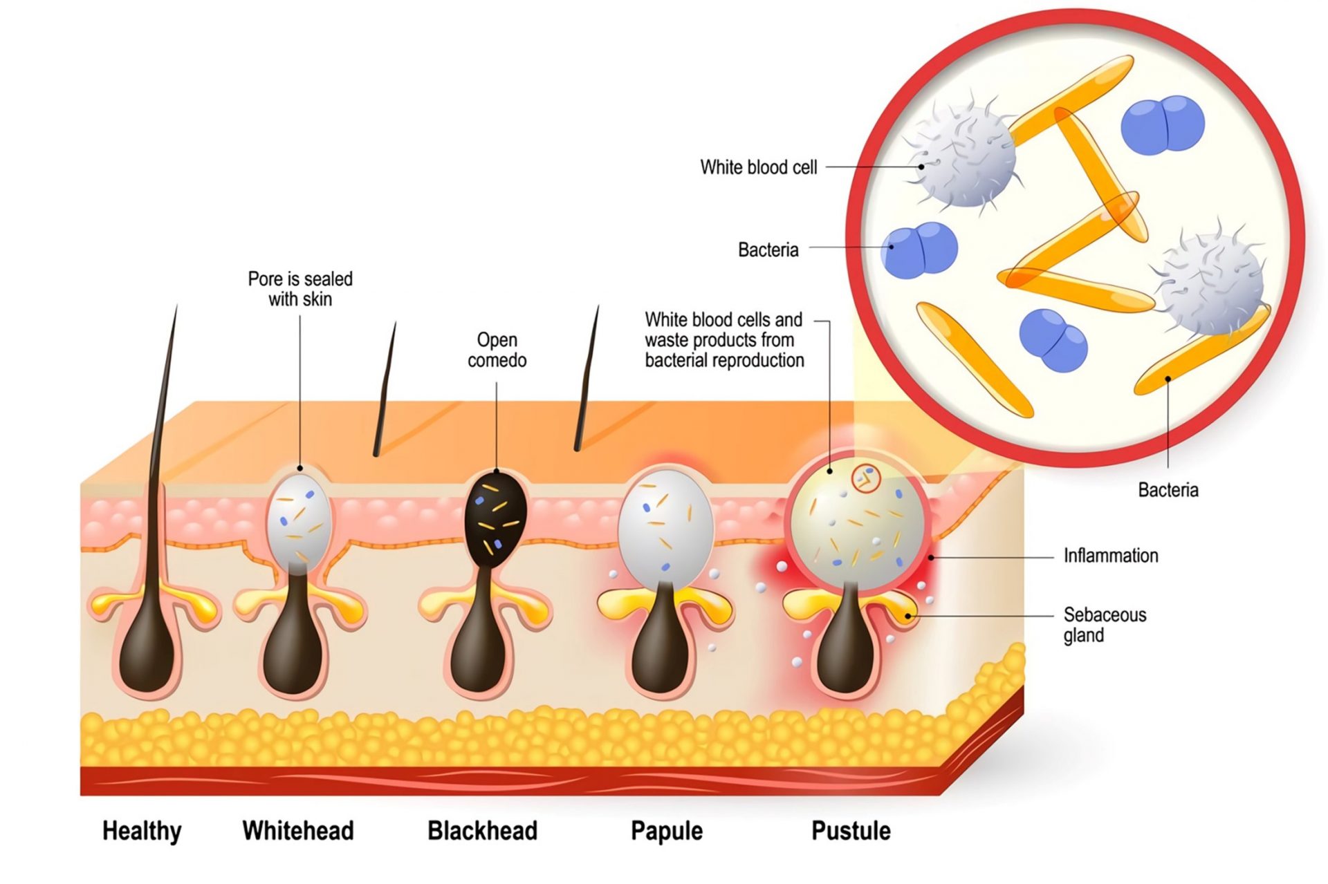 What Causes Acne Scars And How Long Before It Fades? Dream Plastic