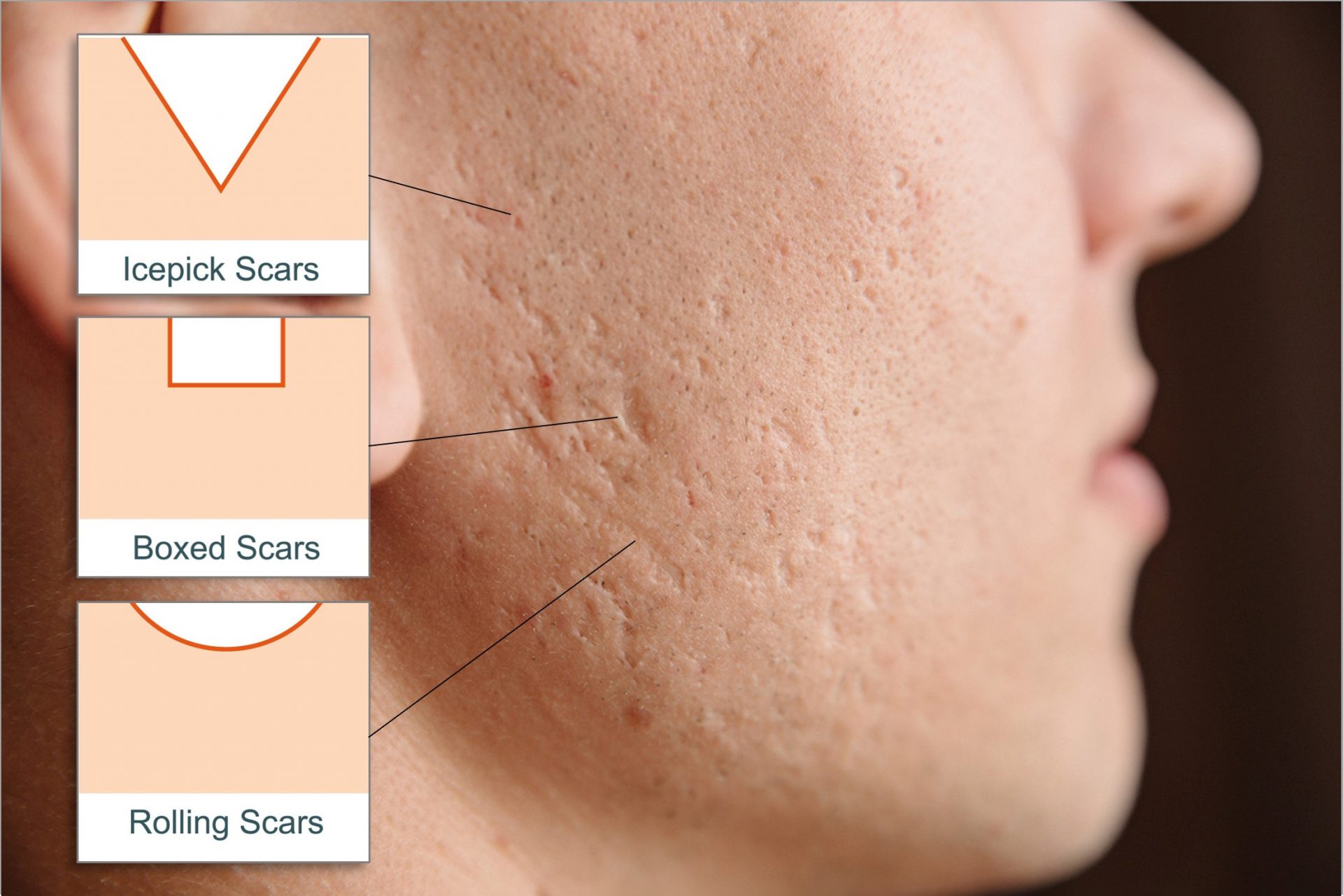 Pico Laser For Acne Scar Removal Better And Safer? Dream Plastic Surgery