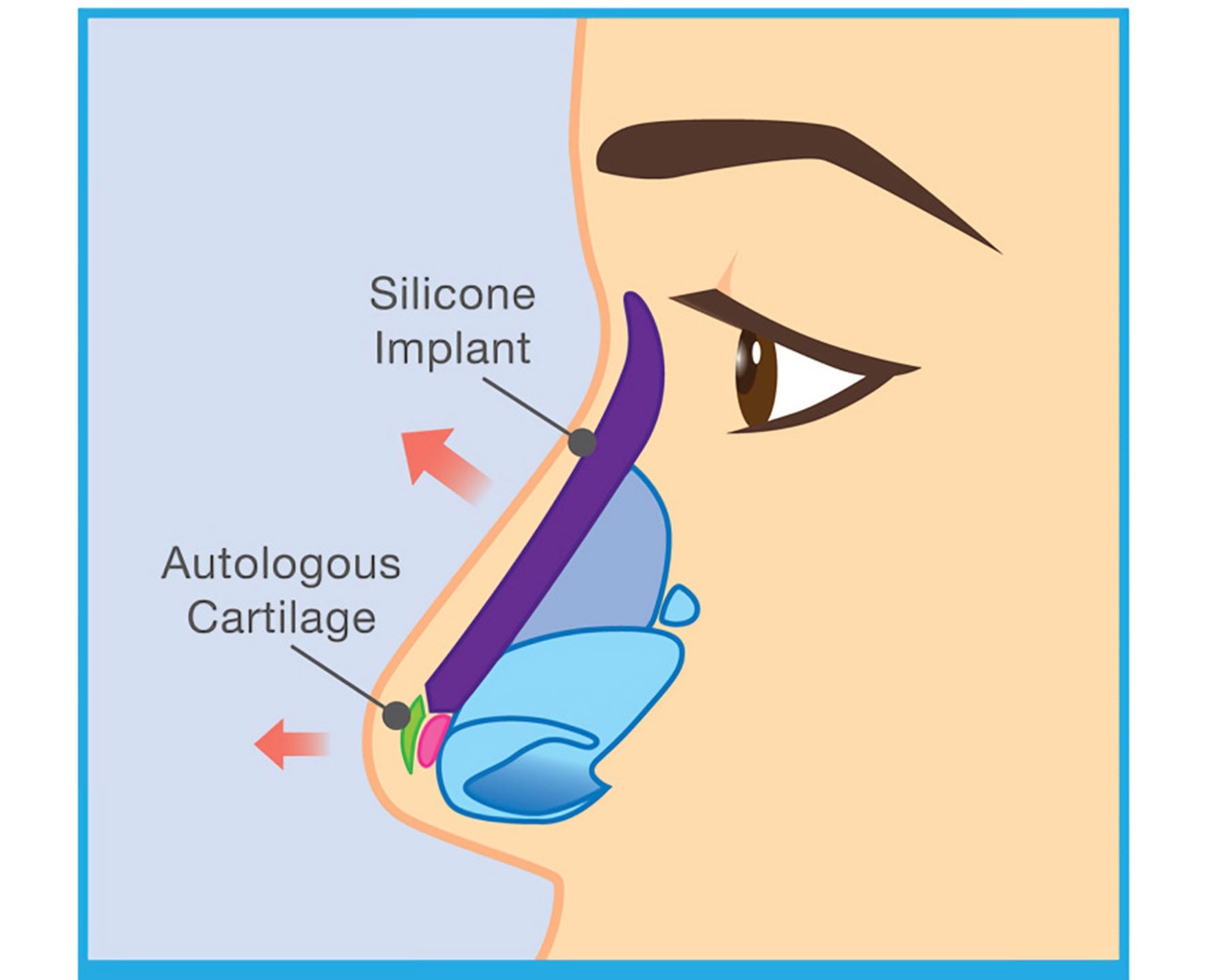 NonSurgical Nose Job VS Rhinoplasty Exploring The Pros & Cons Dream