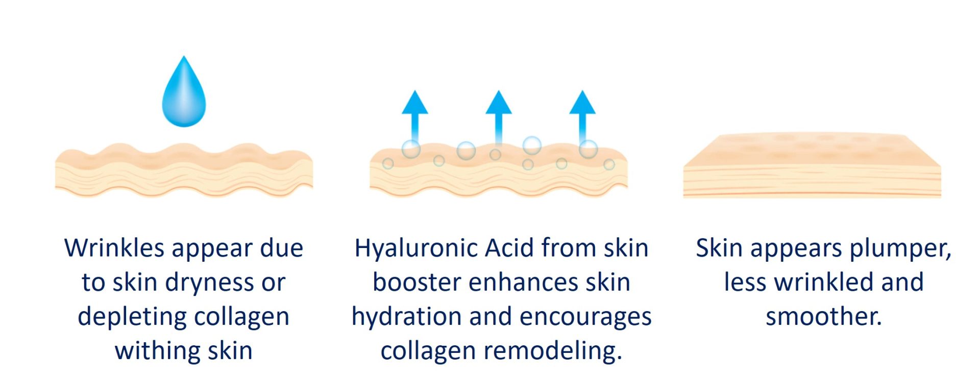 Skin Boosters Which One To Choose & What Benefits Does Each Of Them