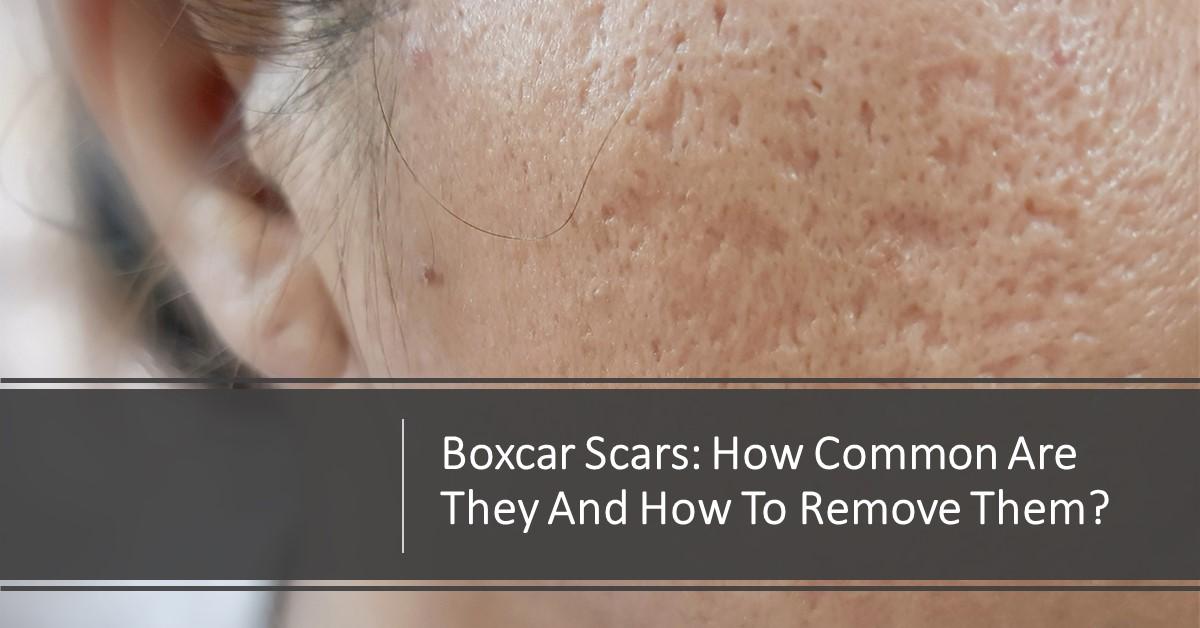Boxcar Scars How Common Are They and How to Remove Them? Dream Plastic Surgery