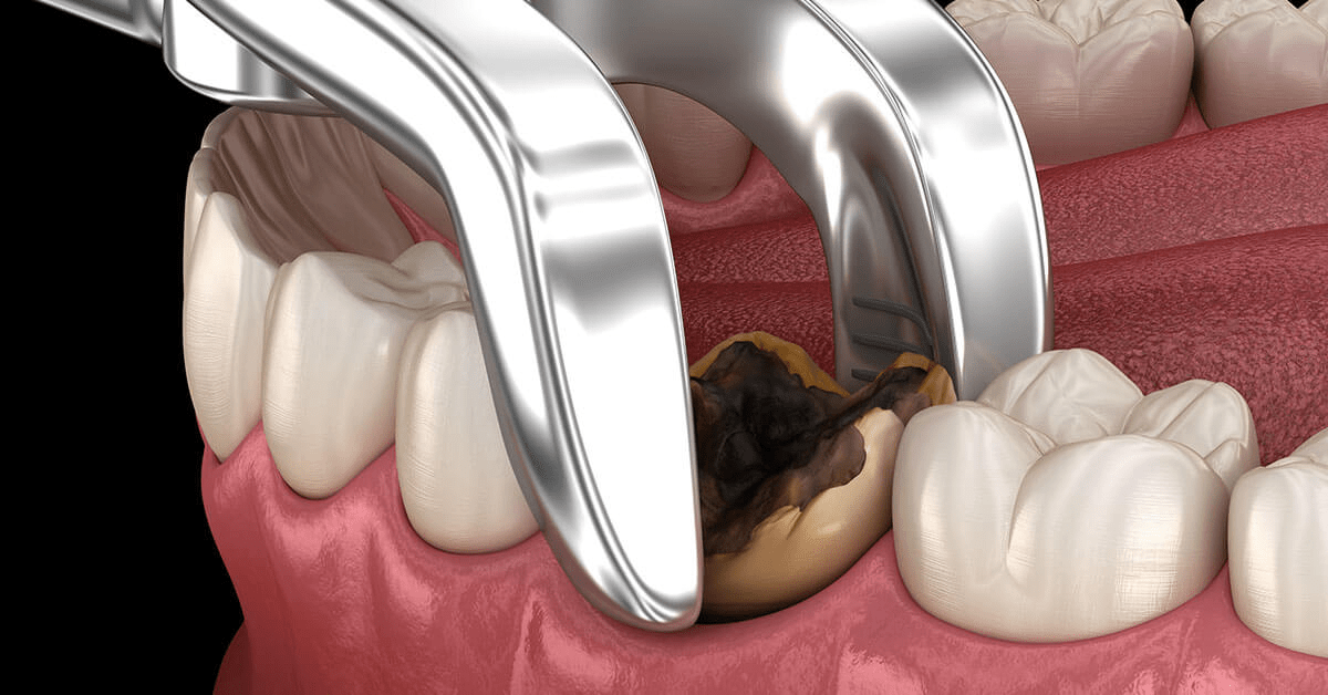 Tooth Extraction Cost, Procedure, Risks, and Recovery Dreamworks