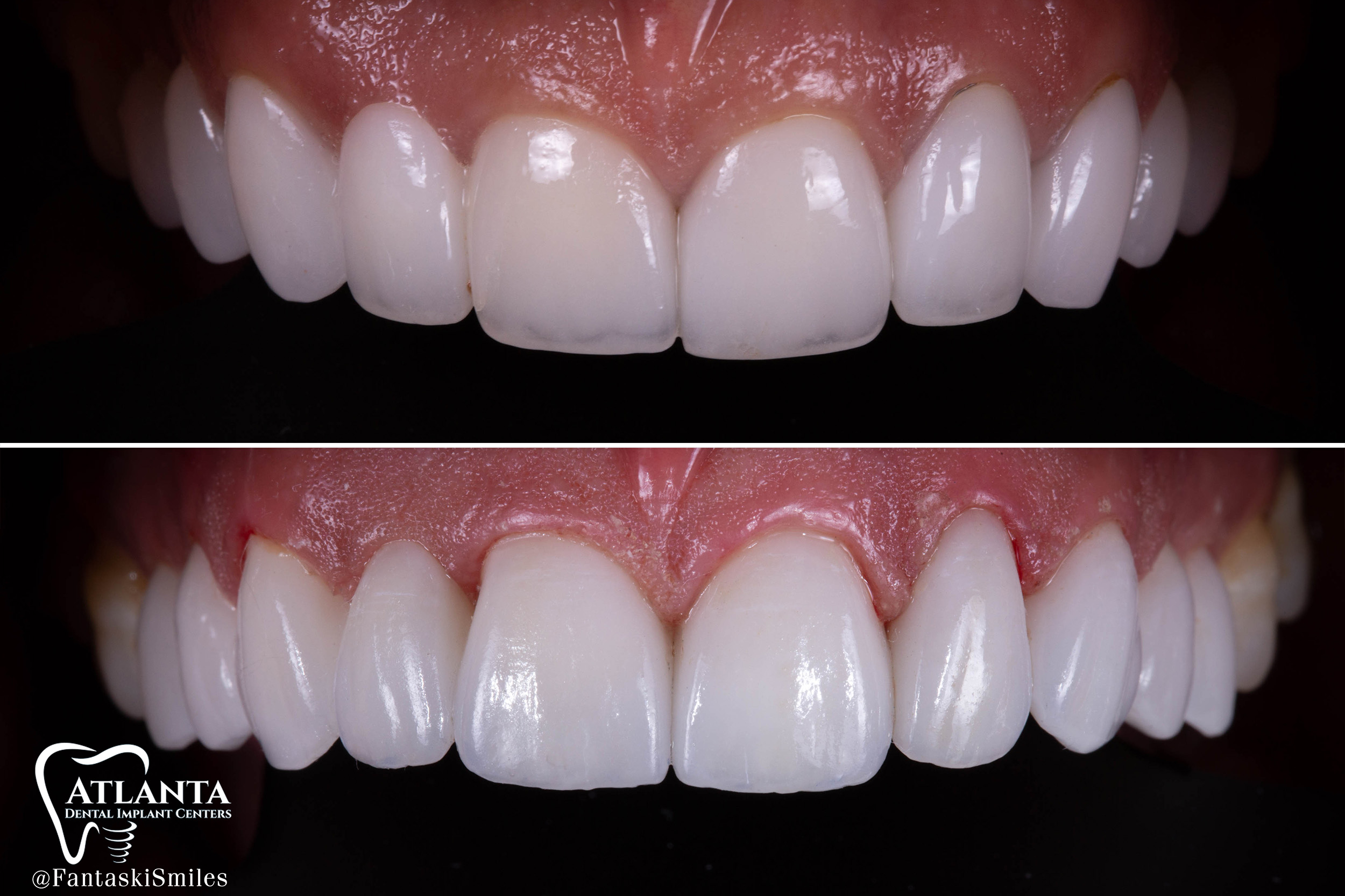 Cosmetic Veneers FantaskiSmiles