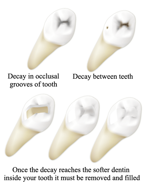 Fruin Family Dentistry Cavities