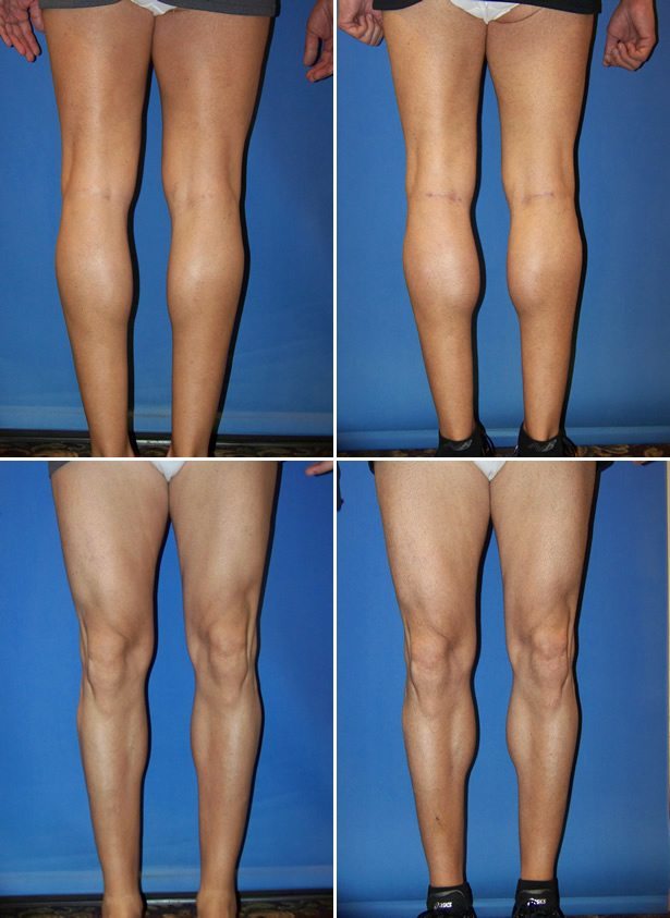 Calf Implants Dr. G Cosmetic Surgery
