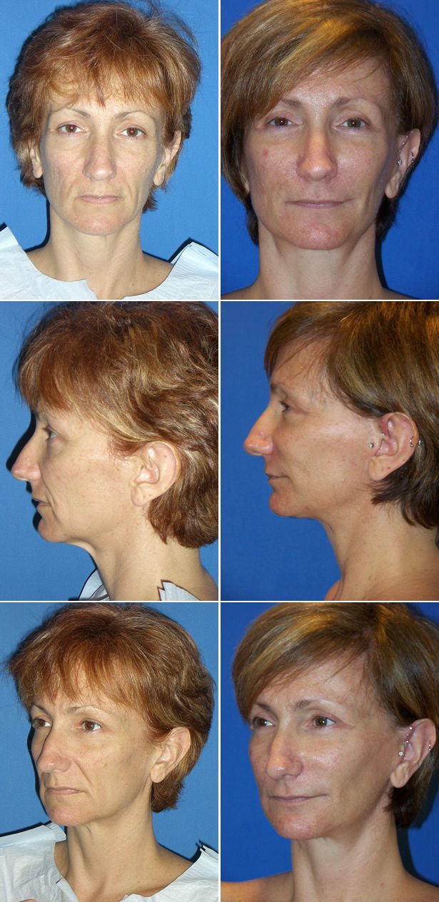 Facelift Dr. G Cosmetic Surgery
