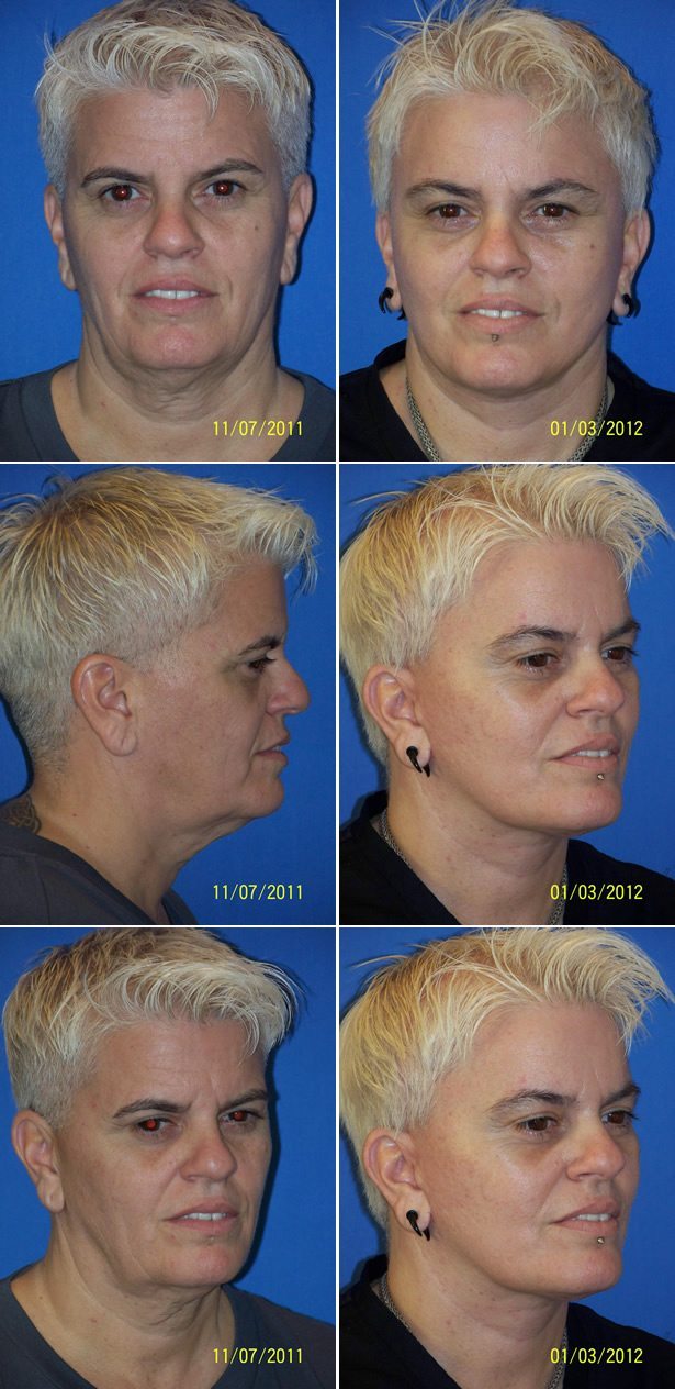 Facelift Dr. G Cosmetic Surgery