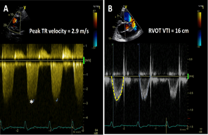 Pulmonary Vascular Resistance - Dr. Ghazal
