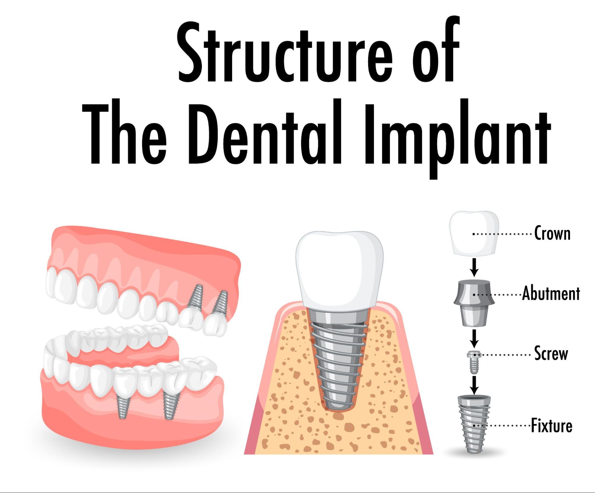 Dental Implants in Hyderabad Implantologist in Hyderabad Dr. Gowd