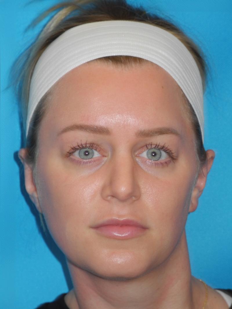 Otoplasty In Philadelphia Ear Pinning In Main Line, PA