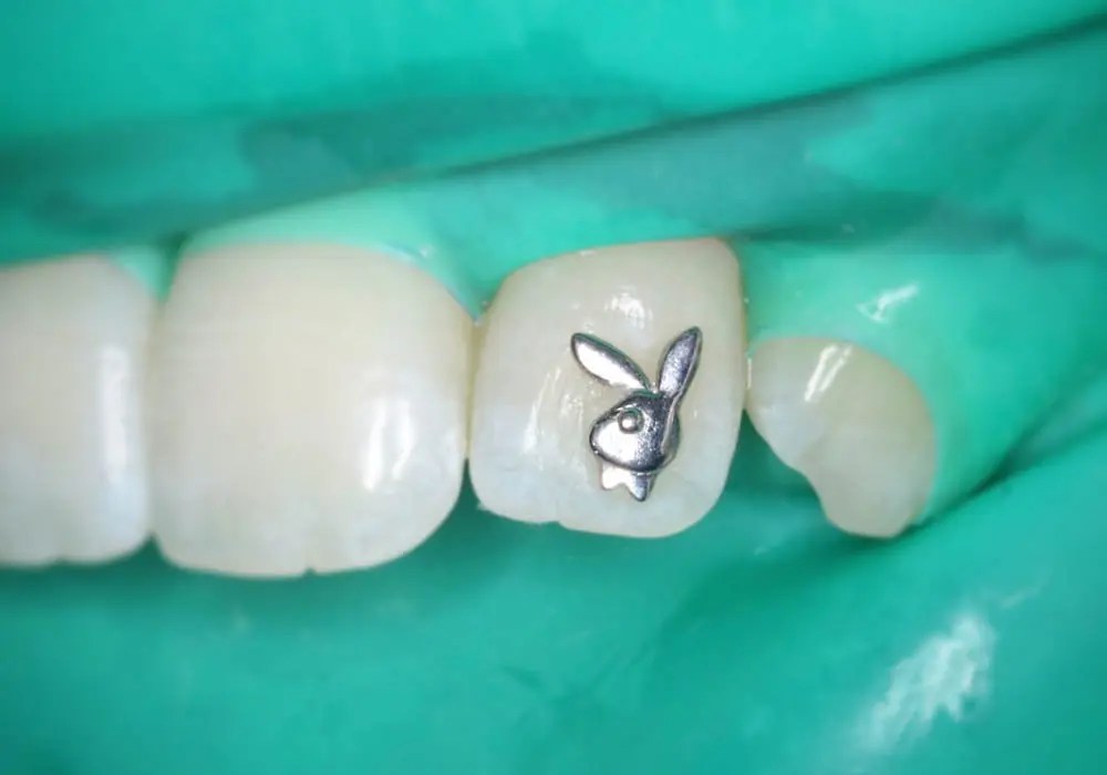 Single Premium 22K Gold Tooth Gem Dr Grillz