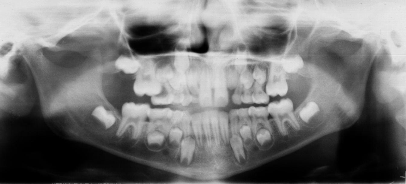 Ectopic Eruption Dr. G's Toothpix