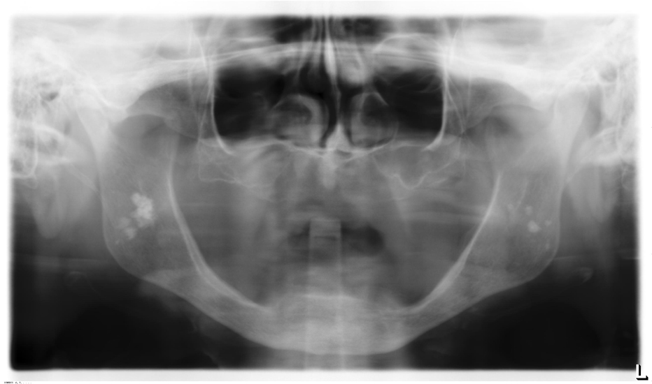 Tonsiliths Dr. G's Toothpix