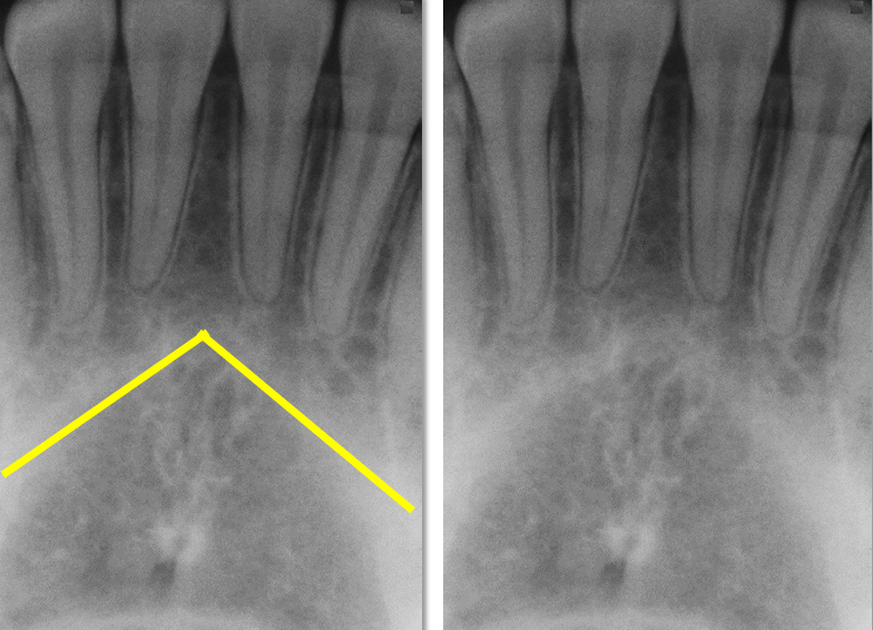 Anatomy on Radiographs Intraoral Radiographs Part I Dr. G's Toothpix