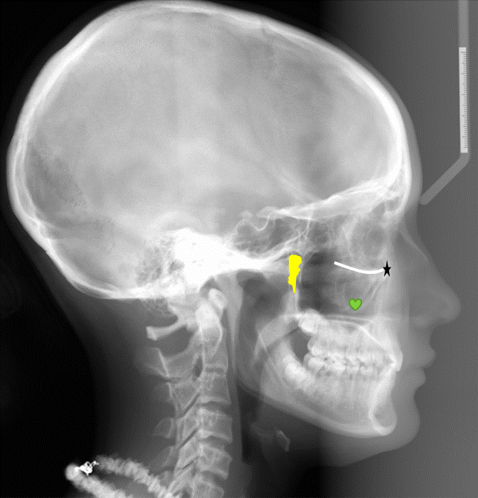 pterygomaxillary fissure Dr. G's Toothpix