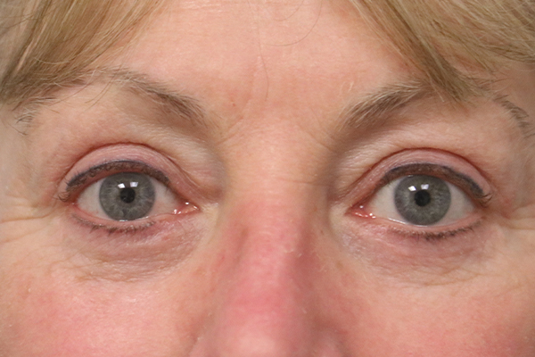 Blepharoplasty Case 846 Dr. Guy