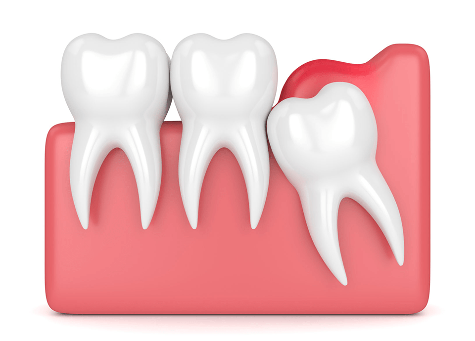 Tooth Extraction BelekDent Antalya/Belek/Serik