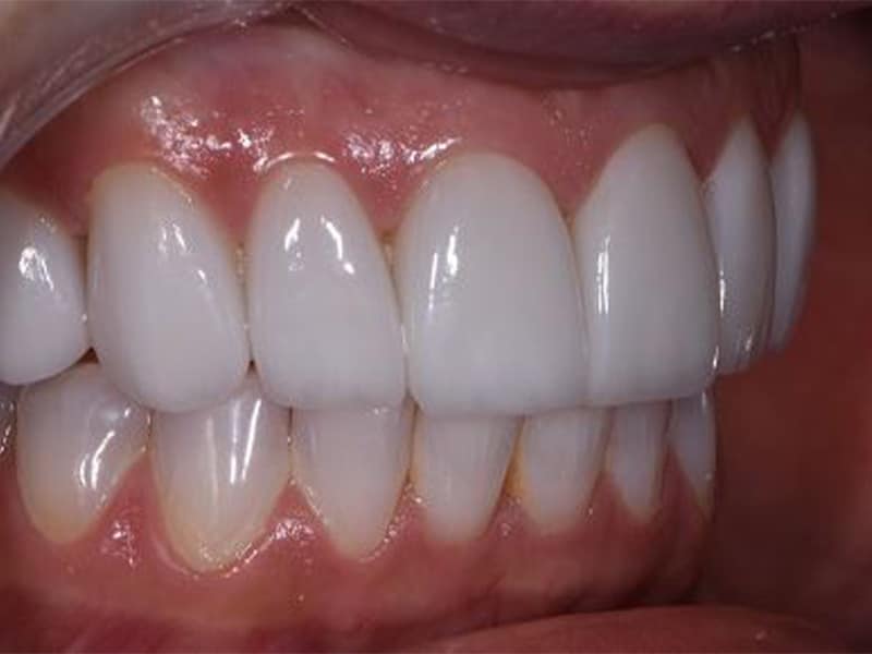 Nashville Porcelain & Prepless Dental Veneers Veneer Dentistry