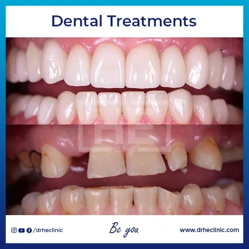 Dental Crowns in Turkey Cost & Reviews