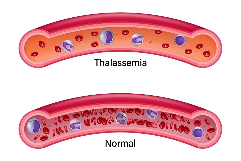 Comprehensive Guide on Thalassemia in Children Causes, Symptoms