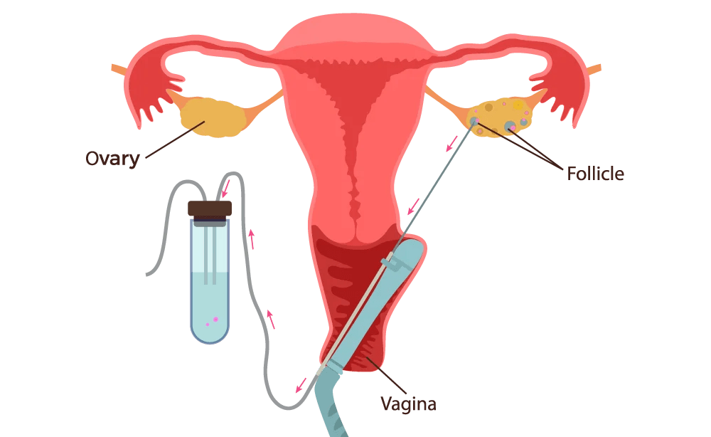 ASPIRATION OFF EGGS Dr Invitro International Turkish Hospital IVF