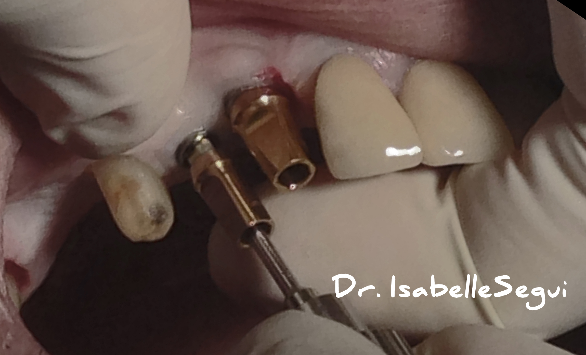 Dental Implants DR. ISABELLE SEGUI