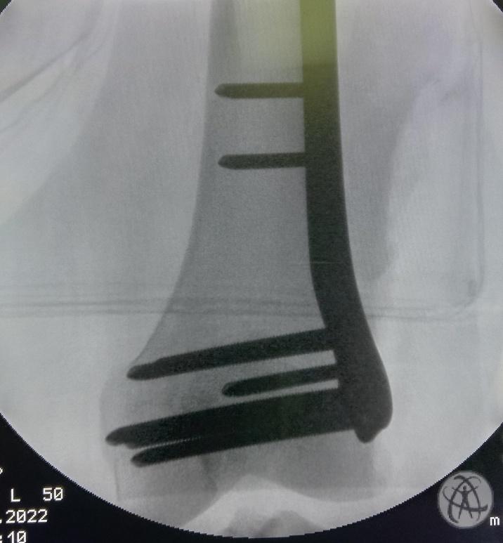 Best Knee Replacement Surgeon in Bangalore Dr Jagadish Prabhu