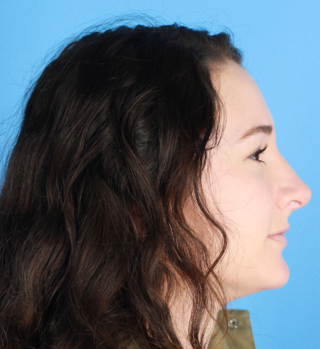 Rhinoplasty Before & After Patient 13 Trillium Plastic Surgery