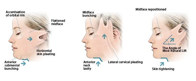 Deep Plane Facelift Sydney Rhytidectomy Australia SMAS Facelift AU