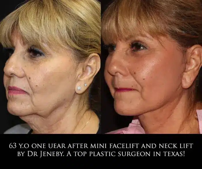 Facelift San Antonio Facial Rejuvenation Austin