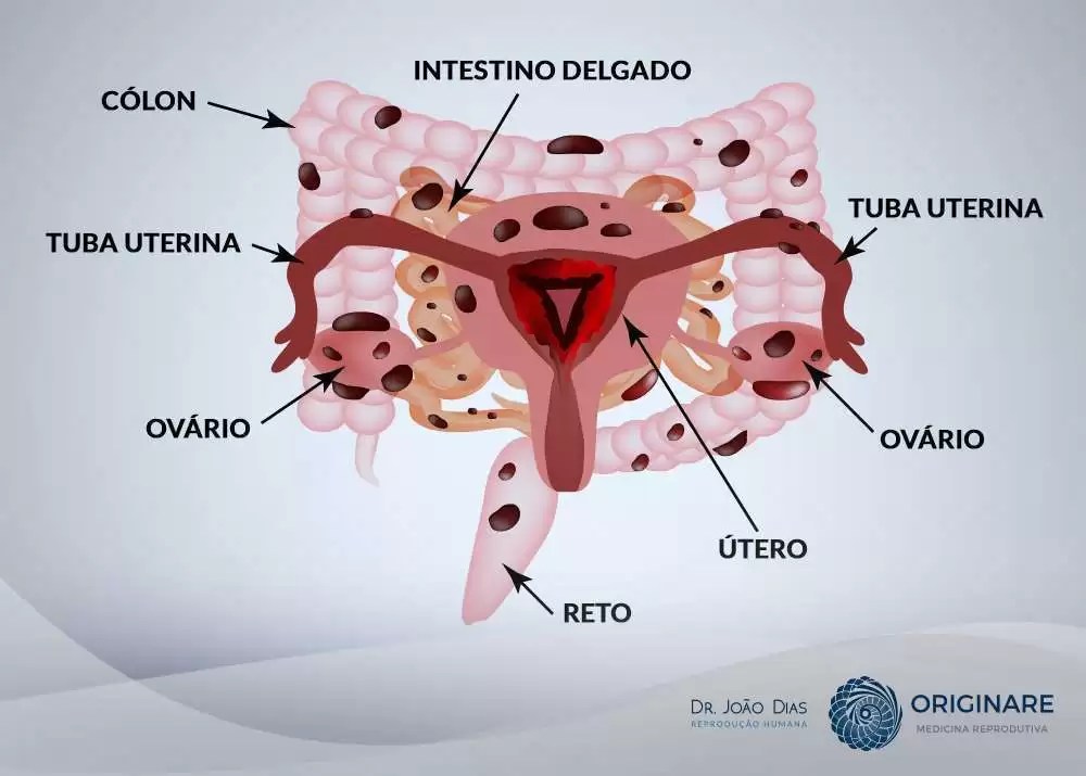 qué es y cómo se trata la endometriosis nuestra casa canal bío My XXX