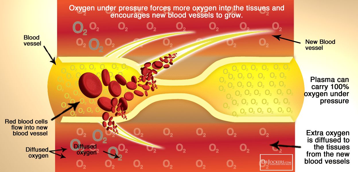 The Health Benefits of HyperBaric Oxygen