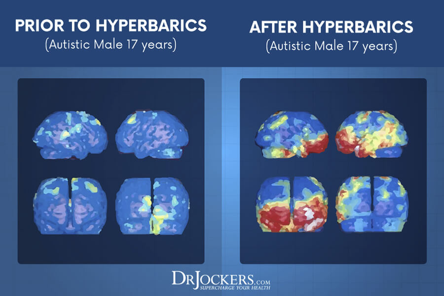 The Health Benefits of HyperBaric Oxygen