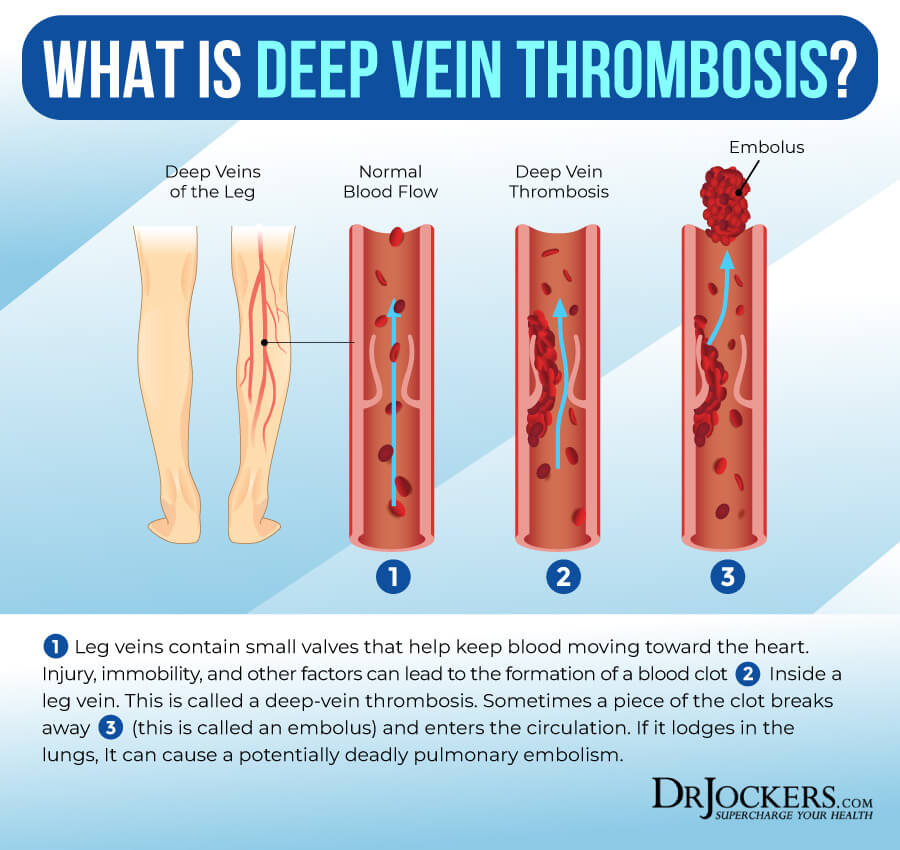 Deep Vein Thrombosis Causes, Symptoms and Support Strategies