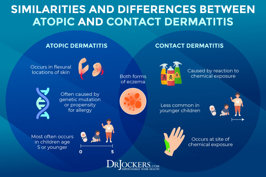 Eczema Symptoms, Causes & Support Strategies