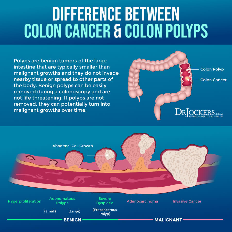 Stages Of Colon Polyps