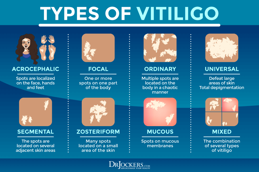 Vitiligo Symptoms, Causes, and Support Strategies