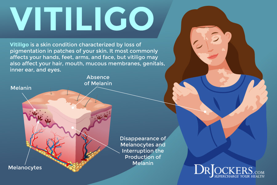 Vitiligo Symptoms, Causes, and Support Strategies